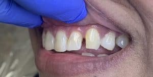 Front Tooth Filling. Beautiful Smile